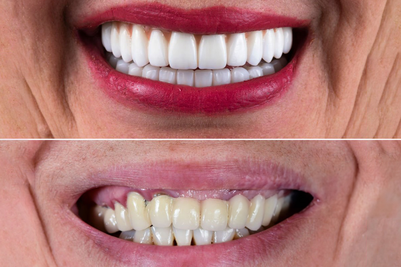 Full Mouth Prosthetic Rehabilitation an Integration of Esthetic...